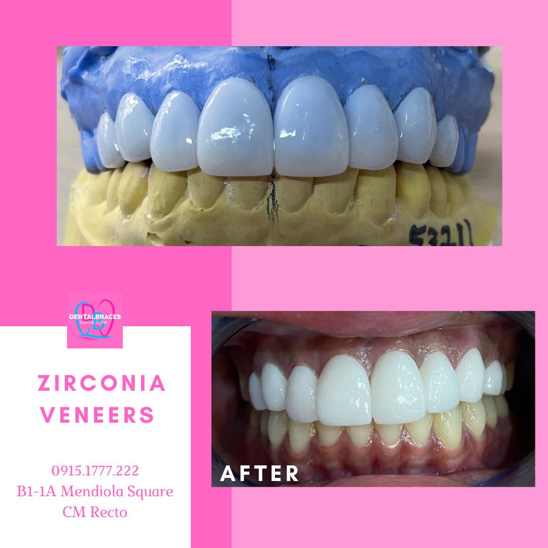 what-are-zirconia-dental-implants-and-how-much-do-they